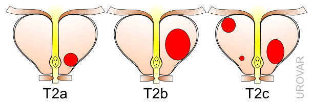 Classification Tnm Gleason Isup Du Cancer De Prostate Centre Durologie Urovar 1397